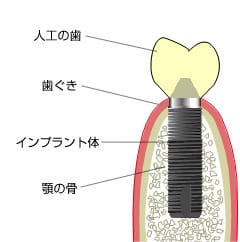 インプラントとは