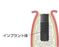 一次手術