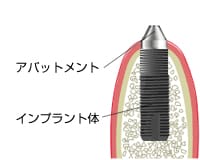 二次手術