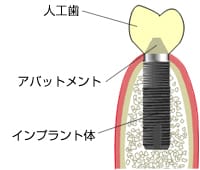 人工歯の装着