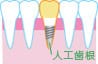 インプラント