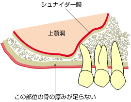 サイナスリフト(上顎洞底挙上術)