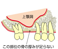 ソケットリフト