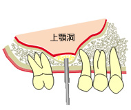 ソケットリフト