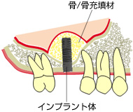 ソケットリフト