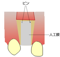 GBR(Guided Bone Regeneration)骨再生誘導法