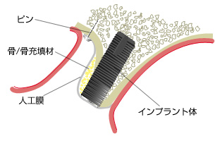 GBR(Guided Bone Regeneration)骨再生誘導法