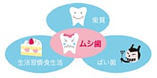 むし歯治療