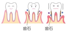 歯周病治療